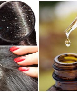 HAIR DANDRUFF REDUCER
