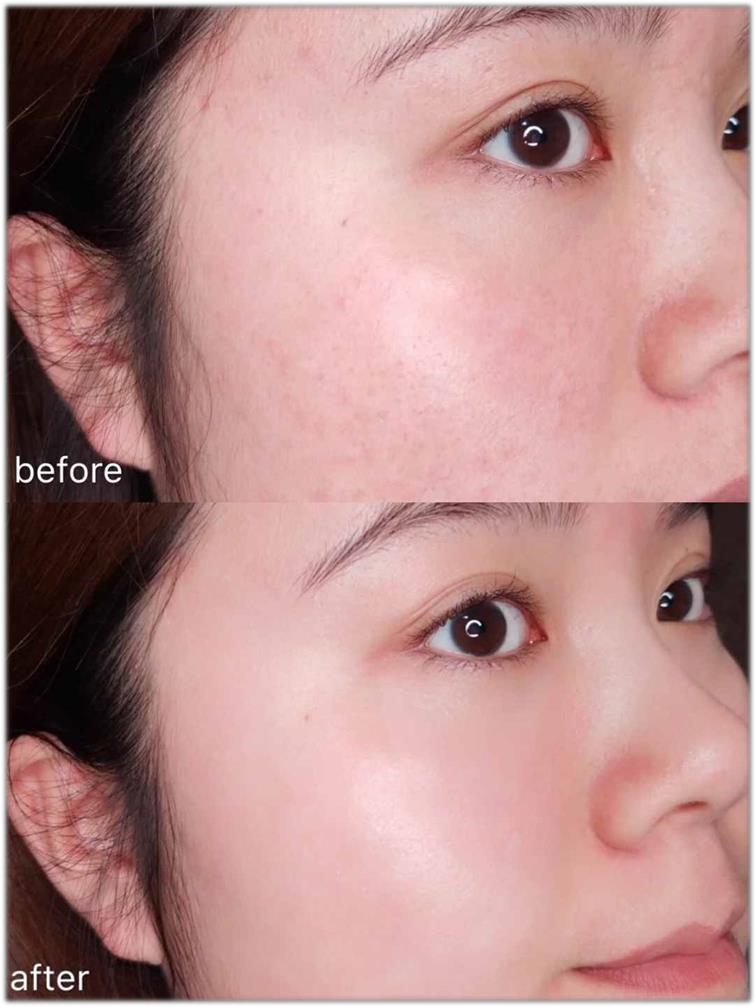 Vitamin K1 Oxide giảm ban đỏ